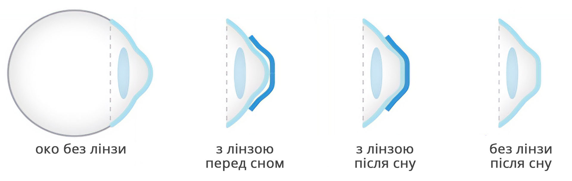 механізм дії нічних лінз